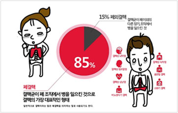 결핵이미지 85% 폐결핵 결핵균이 폐조직에서 병을 일으킨 것으로 결핵의 가장 대표적인 형태 15% 폐외결핵 결핵균의 폐의외의 다른 장기, 조직에서 병을 일으킨 것