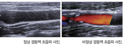 정상 경동맥 초음파사진, 비정상 경동맥 초음파 사진